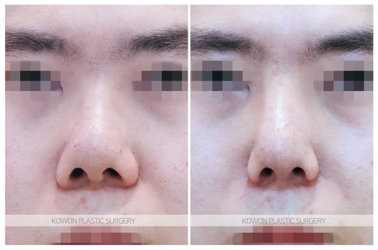 남자 복코재수술 전후사진 : 남자 콧날개줄이기, 비순각 각도 개선 전후사진 수술 기록 사진