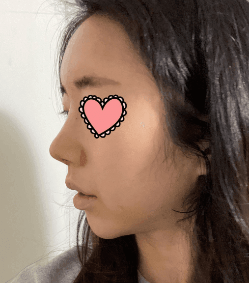 환자수술후기 — 코원으로 달려가라고 추천했습니다 ㅎㅎㅎ♥