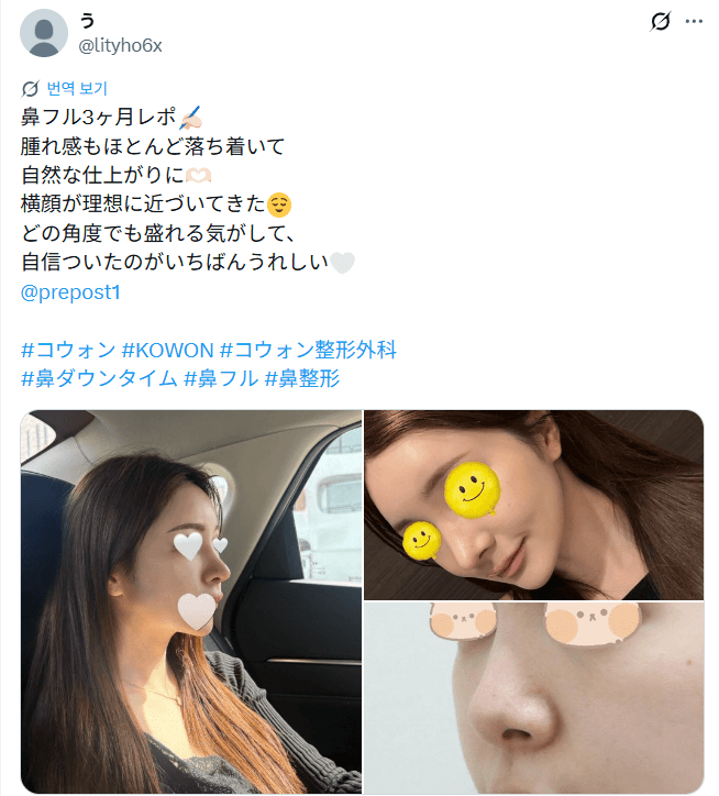 환자수술후기 — 「どの角度でも盛れる気がして自信がついた」鼻整形3ヶ月