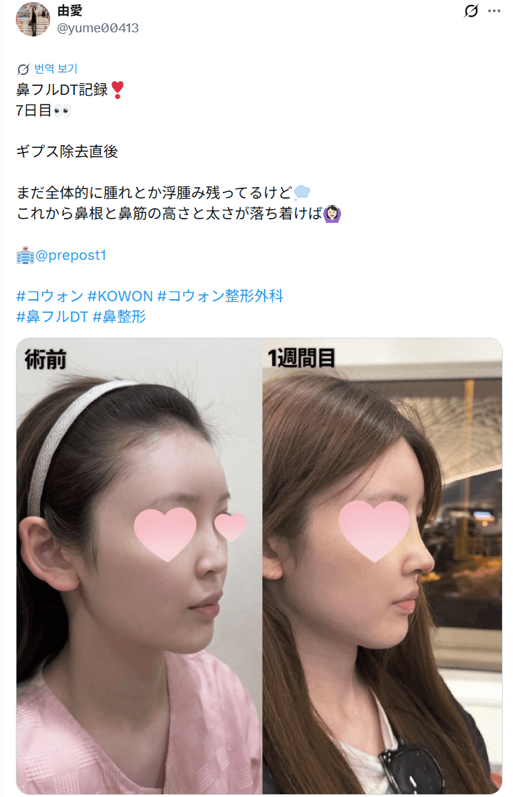 환자수술후기 — 「先生はとても優しくカウンセリングから丁寧」鼻整形1週間