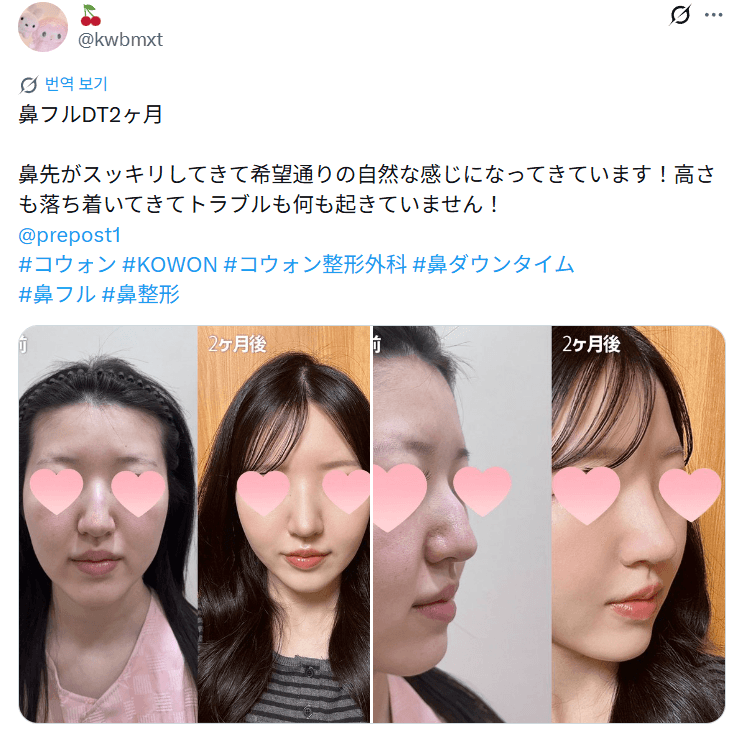 환자수술후기 — 「希望通りの自然な感じ、高さも落ち着いてナチュラル」鼻整形2ヶ月